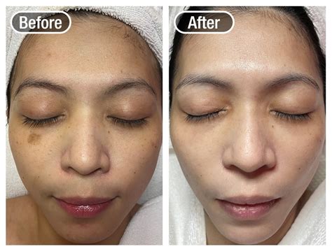 Facial Treatment in SG | Shakura Pigmentation Specialist