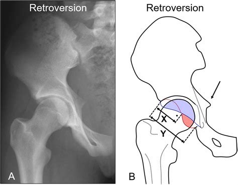 Diagnosis of acetabular retroversion: Three signs positive and ...