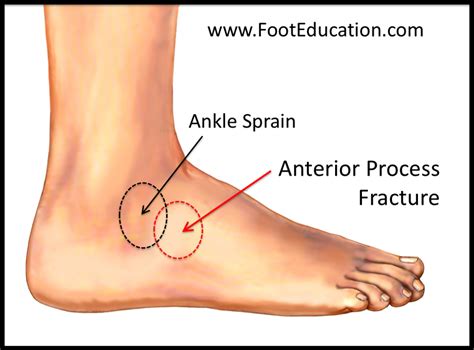 Anterior Process Fracture of the Calcaneus - FootEducation