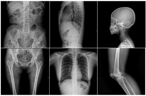 Computed Radiography - radiology health