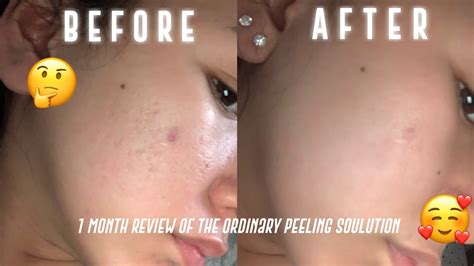 The Ordinary Peeling Solution Review (1month results) - YouTube