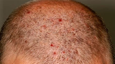 Itchy Red Spots On Scalp