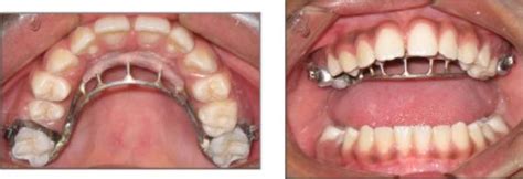 How Your Tongue can Affect Braces