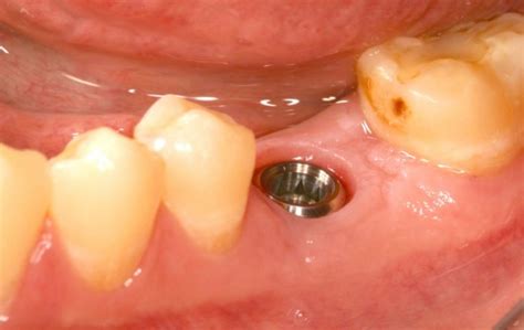 Molar Implant - Dental News Network