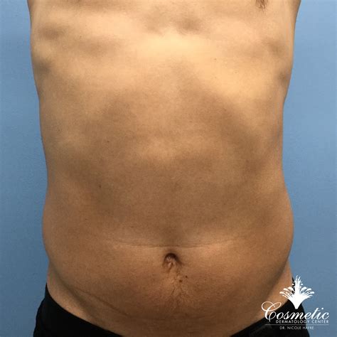 Emsculpt® Muscle Toning and Fat Reduction Treatments In McLean, VA