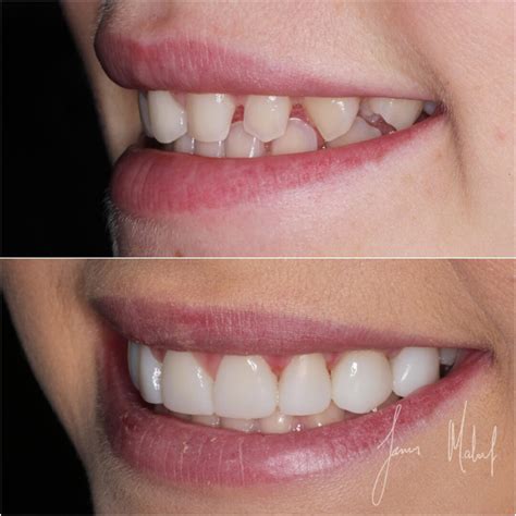 Veneers Before and After Photos - NewMouth