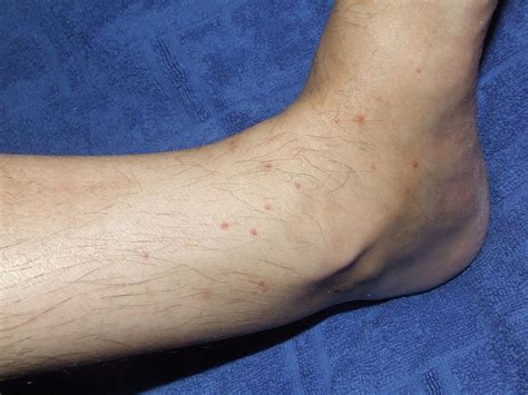 Flea Bites on Humans: Symptoms and Treatment | Dengarden