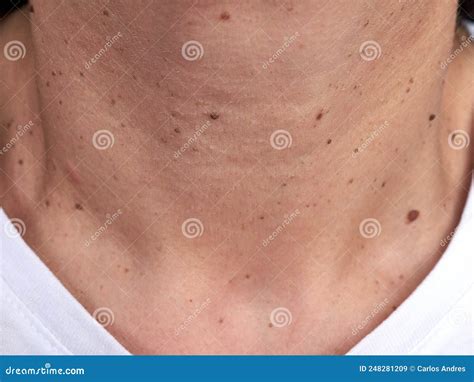 Moles, Warts And Papillomas On Human Skin. Diseases Of The Skin Stock Image | CartoonDealer.com ...