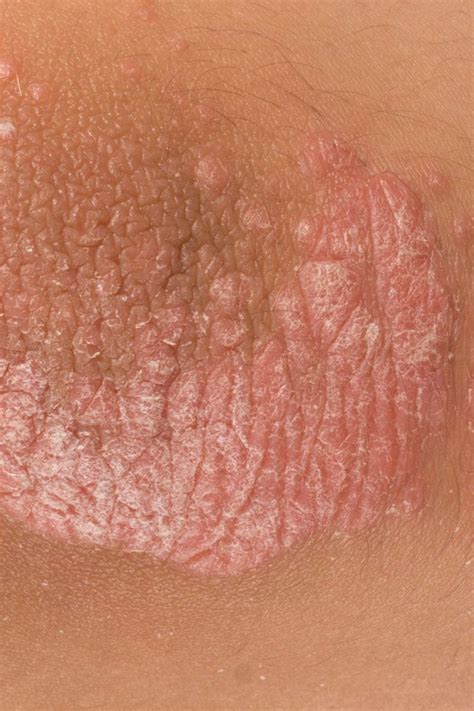 Guttate Psoriasis Symptoms Causes Diagnosis Treatment - vrogue.co