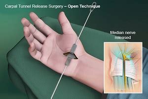 Open Carpal Tunnel Release Surgery Coral Springs, FL | Hand Surgeon ...