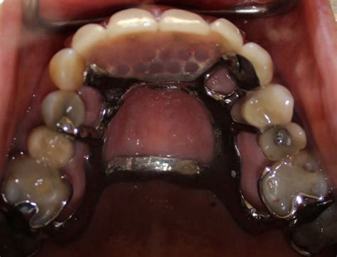 3-case-1-metal-upper-partial-denture-in-mouth