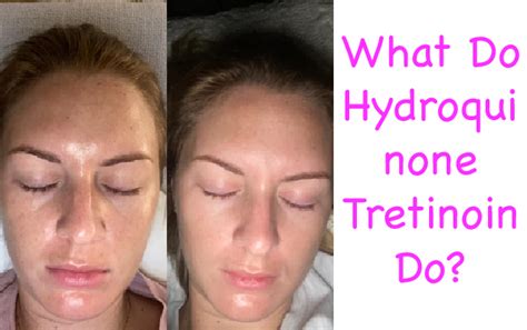 What Do Hydroquinone Tretinoin Do - Rejuvenating Sets