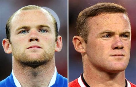 Wayne Rooney Hair Transplantation | Secret Revealed | Cosmeticium