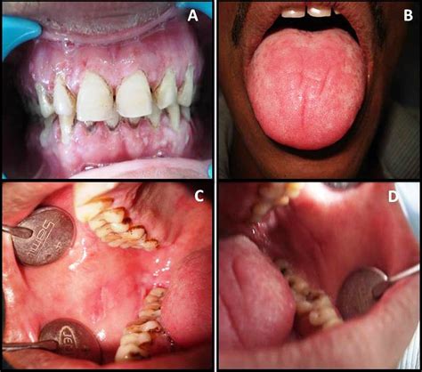 Herpetic Gingivostomatitis Gums