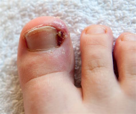 List 90+ Pictures What Does A New Toenail Growing In Look Like Excellent