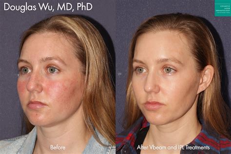 What to Expect Before, During, and After IPL Photofacial Treatment ...