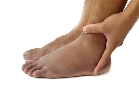 Fort Worth Foot Swelling treatment • Fort Worth Foot and Ankle