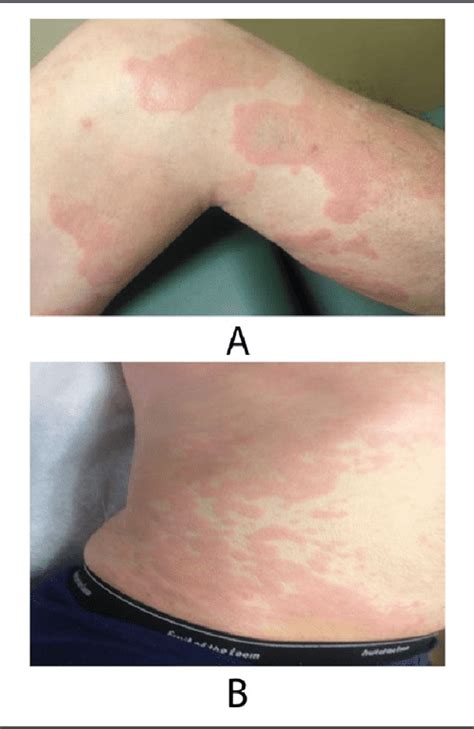 Figure 1 from Schnitzler Syndrome Without a Monoclonal Gammopathy ...