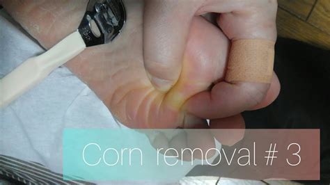 Deep foot corn removal # 3 - YouTube