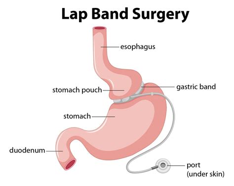 Be aware of Pros & Cons of Lap Band Surgery - Healthy Living Retreats - A healthy lifestyle ...