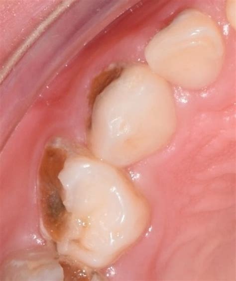 Carious lesions on primary molars: three different strategies | Dentistry33