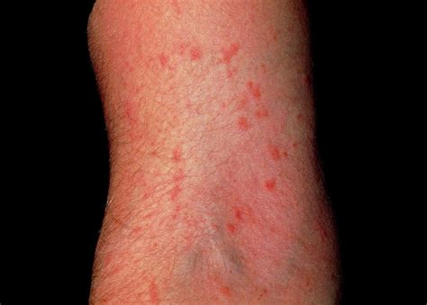 Scabies Infection On The Arm Photograph by Dr H.c.robinson / Science ...