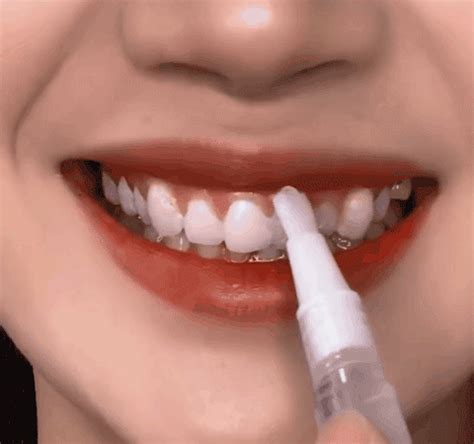 Teeth Whitening Gel Pen – infinitias