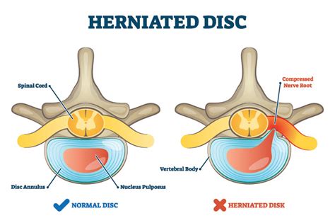 Ask Dr John Esq. - What Are Epidural Steroid Injections? - Diller Law Personal Injury Law