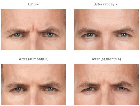 Botox Frown Lines Before And After