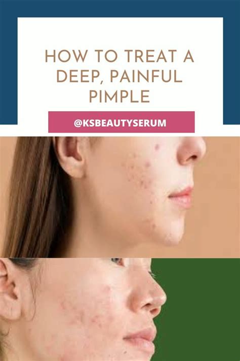 How to treat a deep painful pimple – Artofit