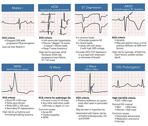 Pin by Andres Sanchez on EKG | Nursing mnemonics, Cardiology nursing ...