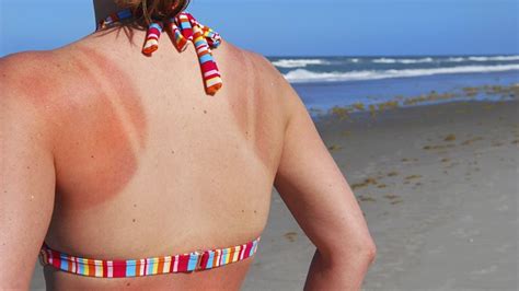 5 Sunburn Treatments to Save Your Vacation | Everyday Health
