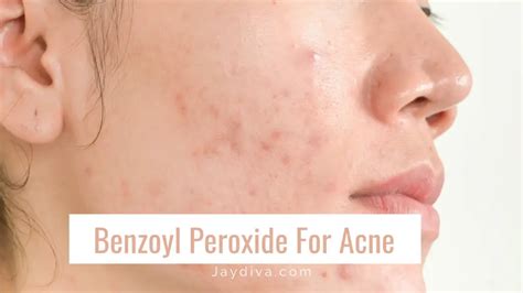 How to Use Benzoyl Peroxide for Acne to See Results - Jaydiva