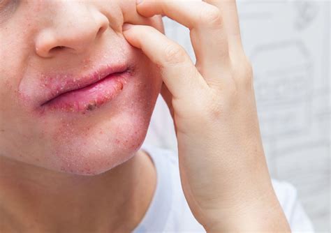 Eczema on Lips: Symptoms, Triggers, Home Remedies & Treatments