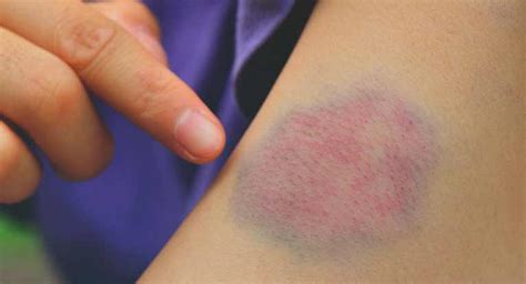 Blood Clot or Bruise: What’s the Difference?