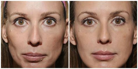 More amazing before and afters of Sculptra. Photos courtesy of Dr. Burke Robinson. #Sculptra ...