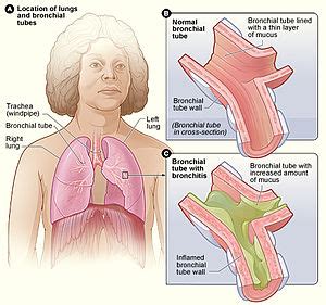 Bronchitis - Wikipedia