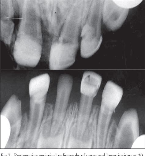 Figure 4 from Dentinogenesis imperfecta: an early treatment strategy ...