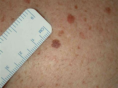 Spot the difference: harmless mole or potential skin cancer?