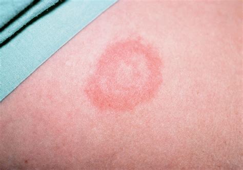 Bull's eye rash is key sign of Lyme disease, leading health watchdog tells doctors | The ...