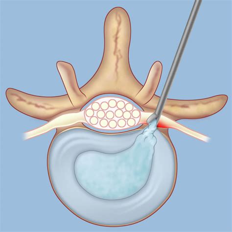 Surgery for a Herniated Disc | Weill Cornell Brain and Spine Center