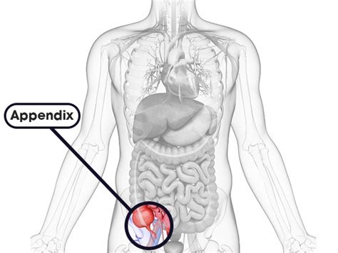 Appendicitis: Causes, Symptoms, Diagnosis & Treatment - Boldsky.com