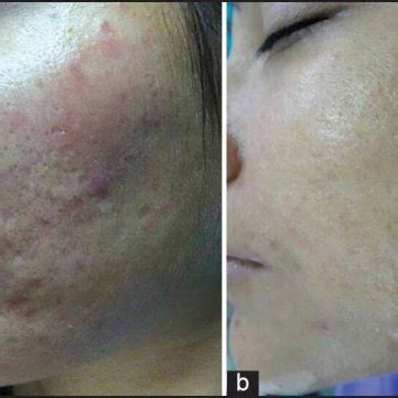 (a) Grade 4 acne scars; (b) Improvement in acne scars from Grade 4 to ...