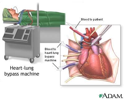 Heart transplant - series—Procedure: MedlinePlus Medical Encyclopedia