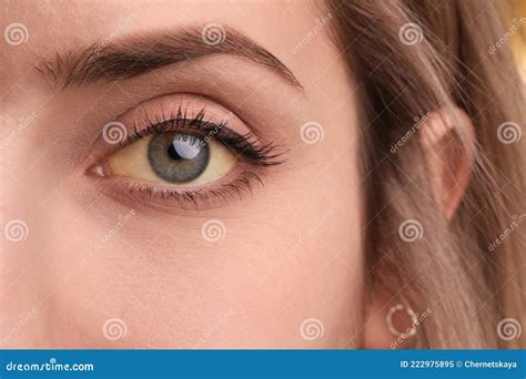 Woman with Yellow Eyes. Liver Problems Symptom Stock Image - Image of caucasian, medicine: 222975895