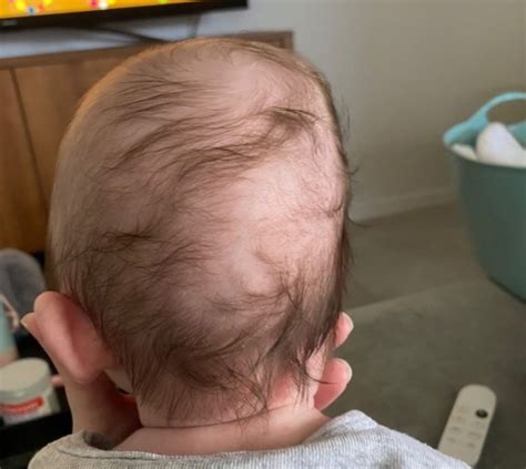 Plagiocephaly