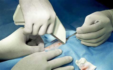 Surgical Stapler Lawsuit – What You Need to Know