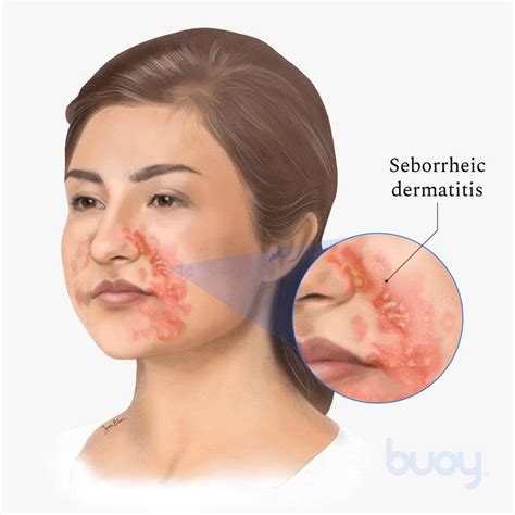 What Causes Seborrheic Dermatitis Face