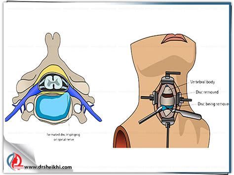 Dr. Alireza Sheikhi |Neck disc surgery and its aftercare | دکتر علیرضا شیخی