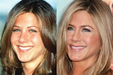 Jennifer Aniston Botox Make Her Talk Funny - Kirkpatrick Primses